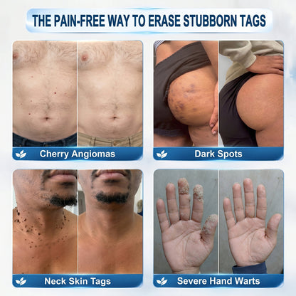 Nuvessaskin® 7-𝐷𝑎𝑦 𝗧𝐚𝐠 & 𝗦𝗽𝐨𝐭 𝐄𝐫𝒂𝒔𝒆𝒓(Zero Pain, Zero 𝐒𝐜𝐚𝒓𝒔 Rollerball) 👀
