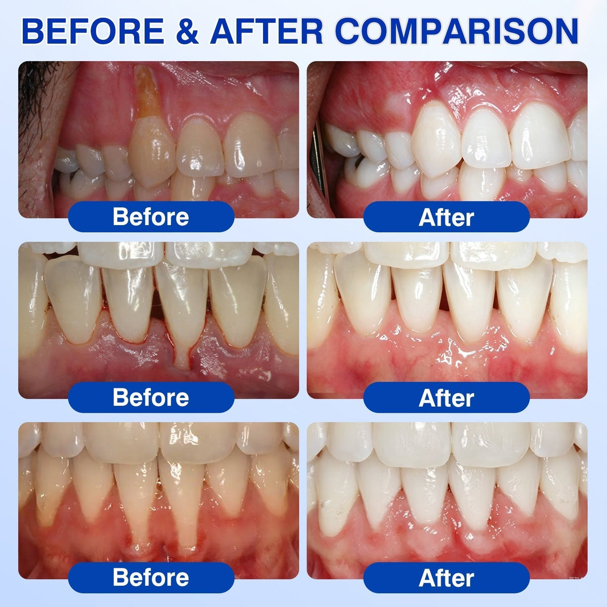 🇺🇸🏅🦷🛡️NuvessaSkin® GumRevive Periodontal Repair Gel