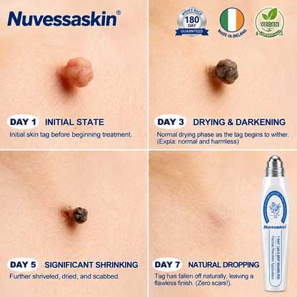 Nuvessaskin® 7-𝐷𝑎𝑦 𝗧𝐚𝐠 & 𝗦𝗽𝐨𝐭 𝐄𝐫𝒂𝒔𝒆𝒓(Zero Pain, Zero 𝐒𝐜𝐚𝒓𝒔 Rollerball) 👀